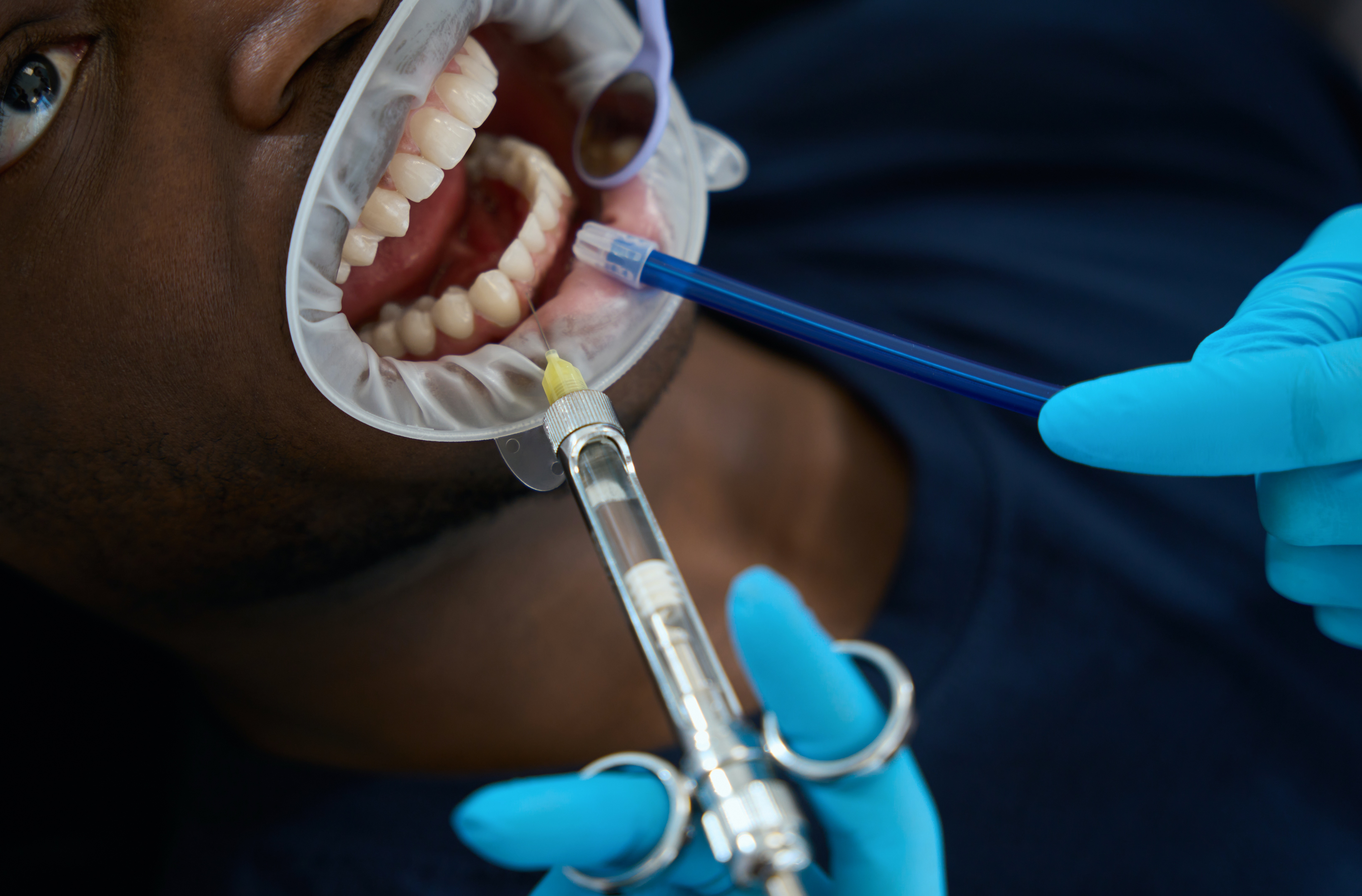 Featured image for What to Expect When Getting Your Wisdom Teeth Removed