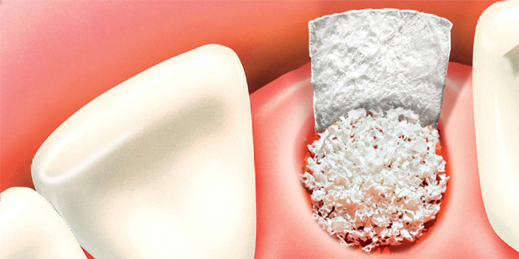 Featured image for What is Bone Grafting Surgery? Types, Recovery & FAQs