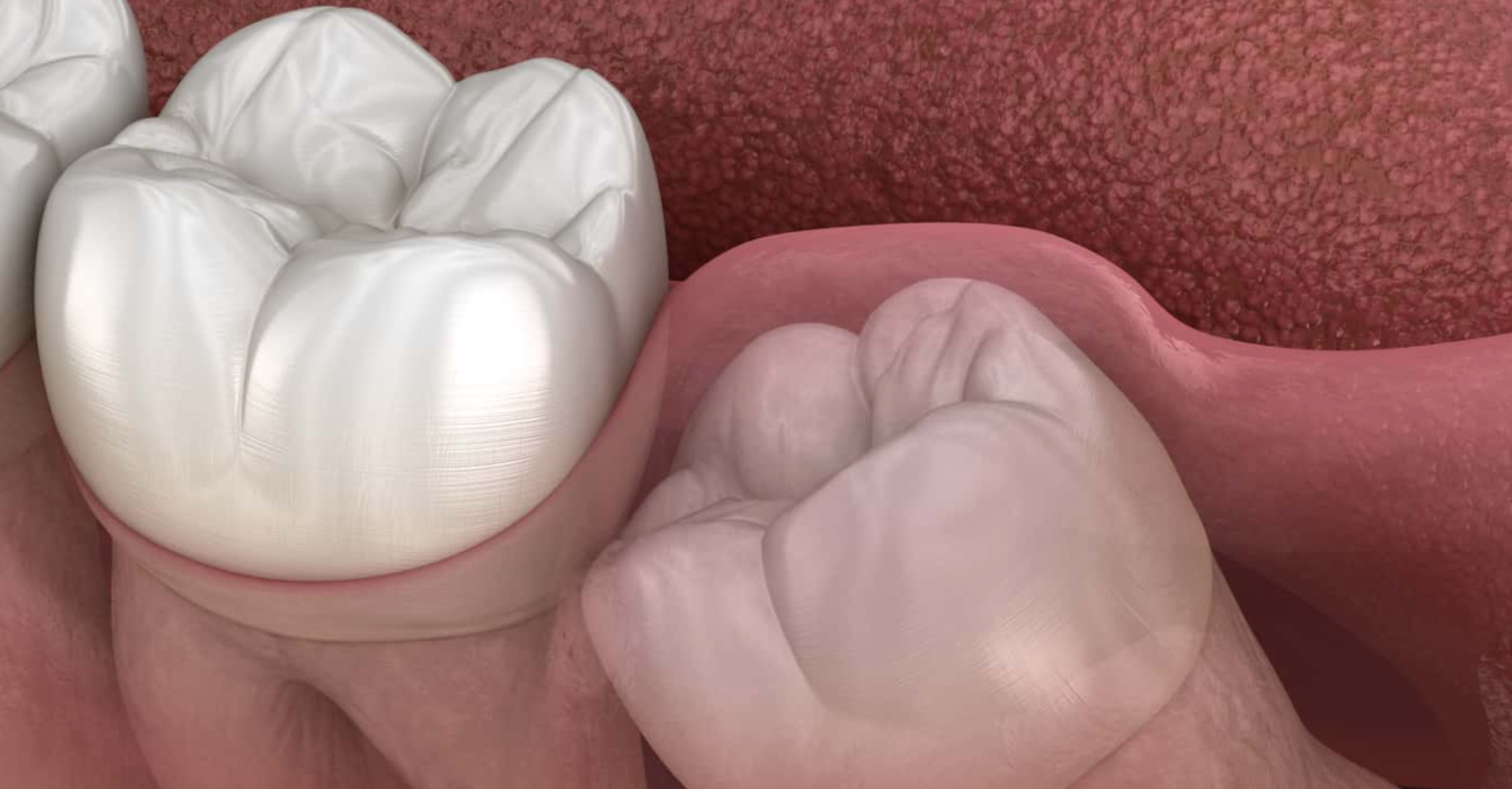 7 Signs You Need Your Wisdom Teeth Removed
