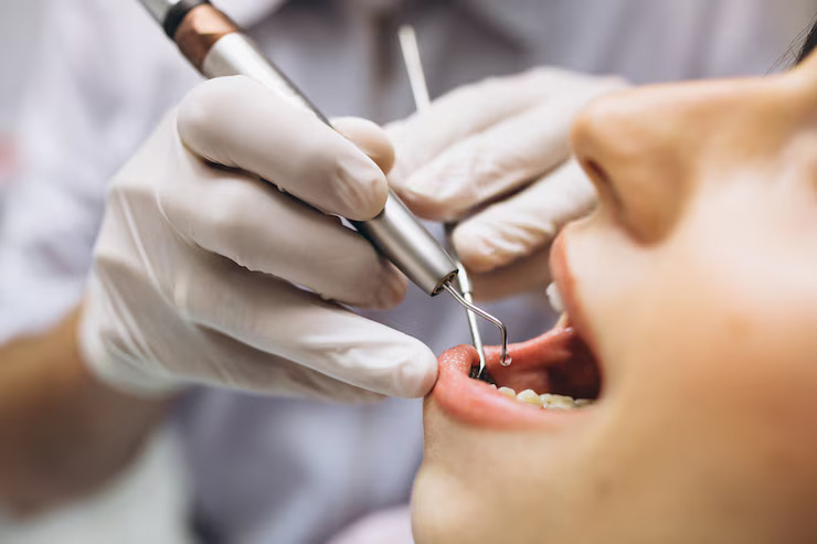 Laser-Assisted Apicoectomy: Future of Periapical Surgery?