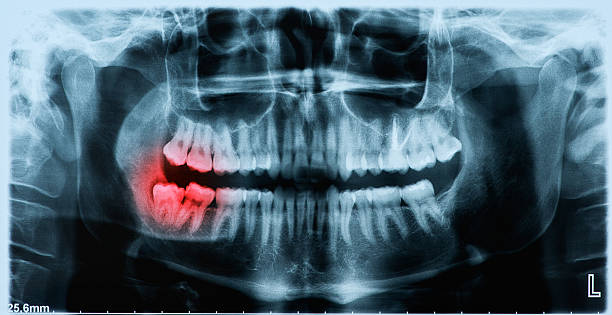 Impacted Wisdom Teeth Symptoms You Shouldn’t Ignore