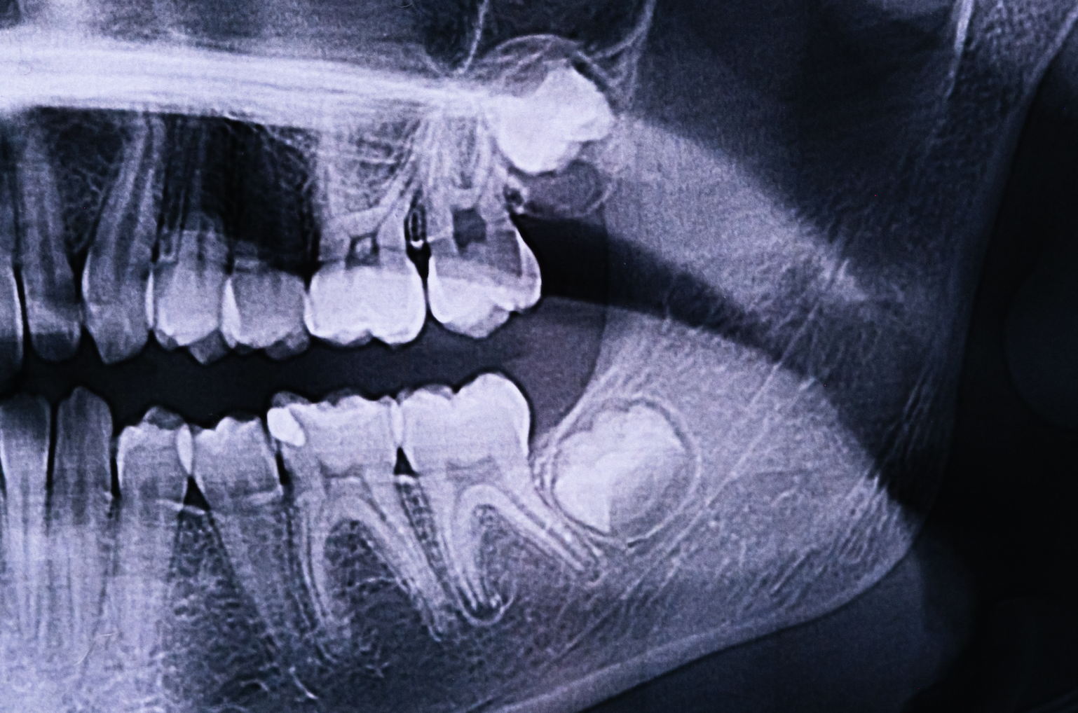   How to Sleep After Wisdom Tooth Surgery: 9 Essential Tips for a Faster Recovery