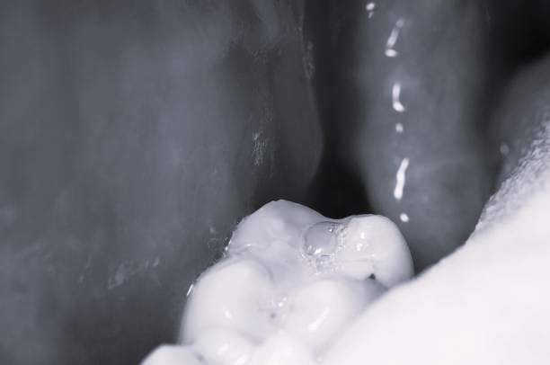 Dry Socket After Wisdom Teeth Removal: Symptoms and Prevention