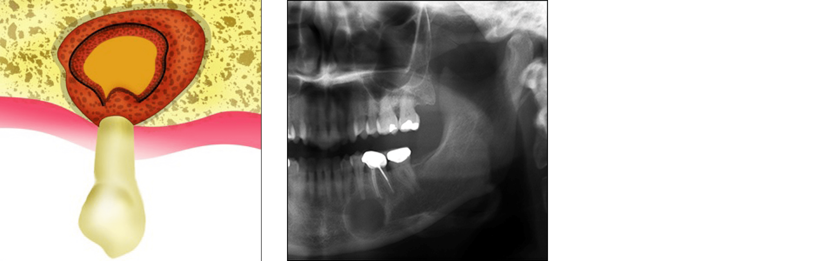 Apicoectomy (Periapical Surgery)