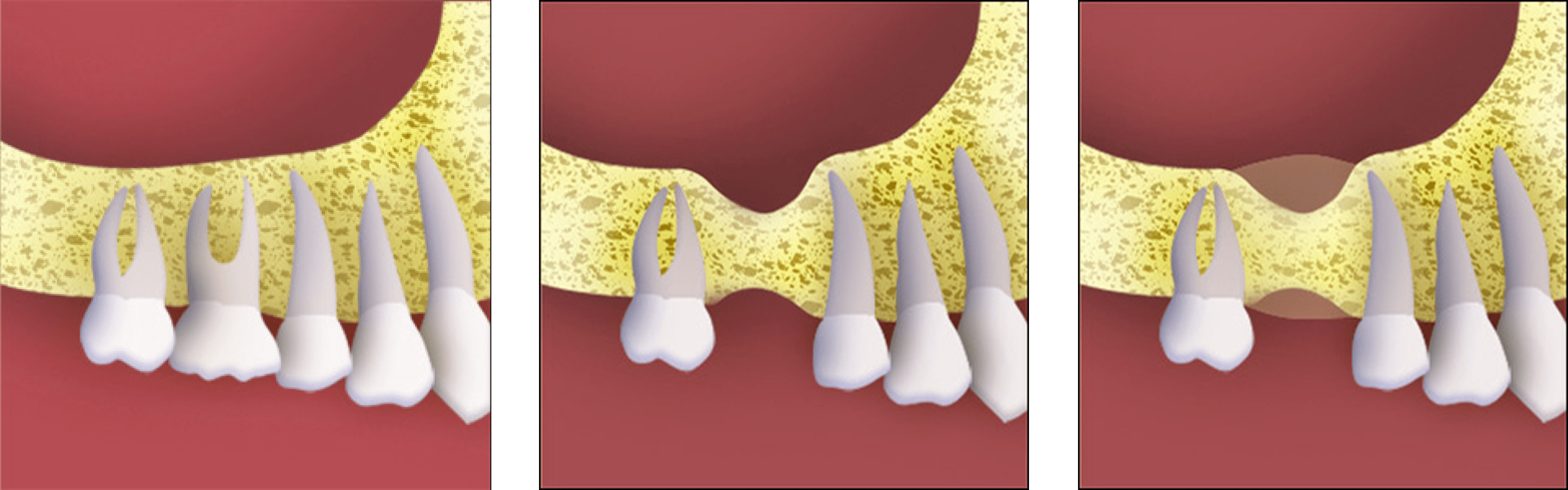 bone-grafting