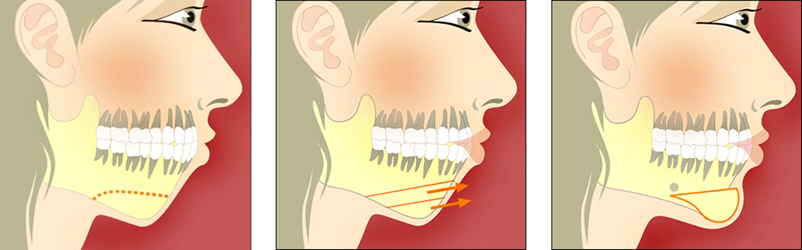 Chin Surgery