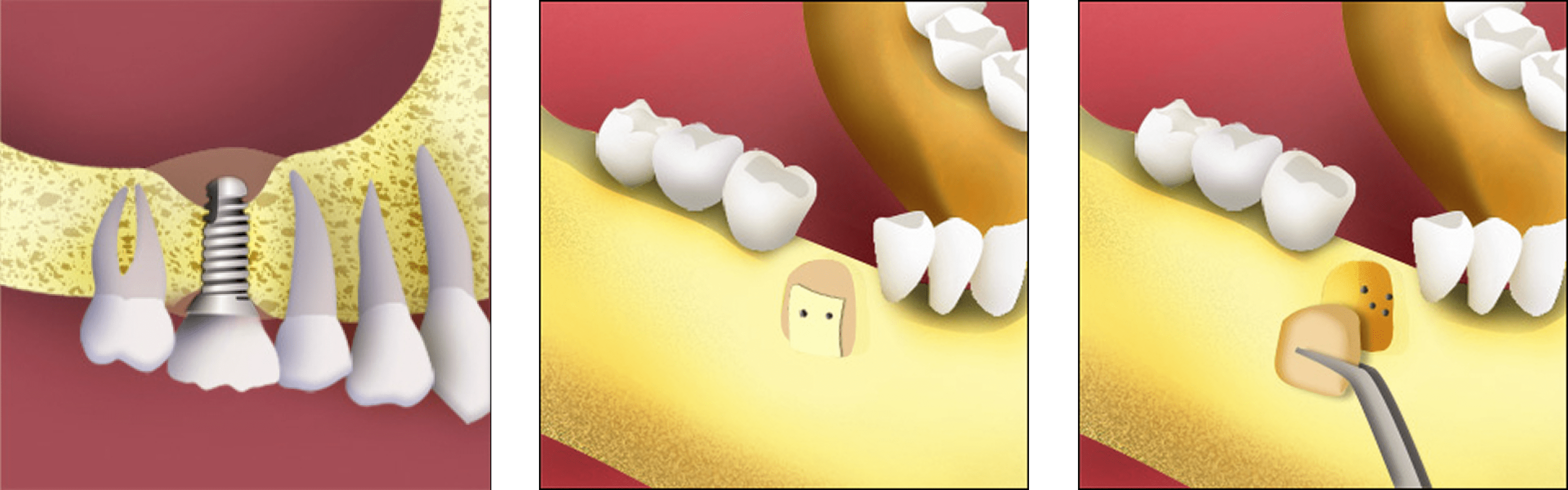 bone-grafting