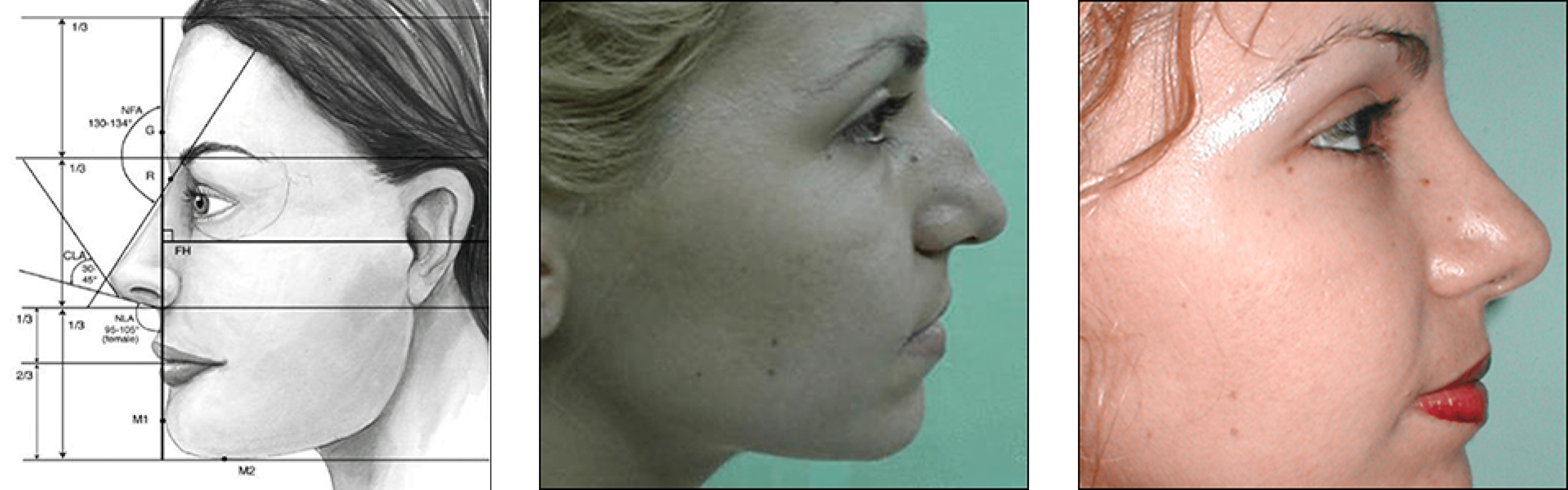 nose surgery rhinoplasty