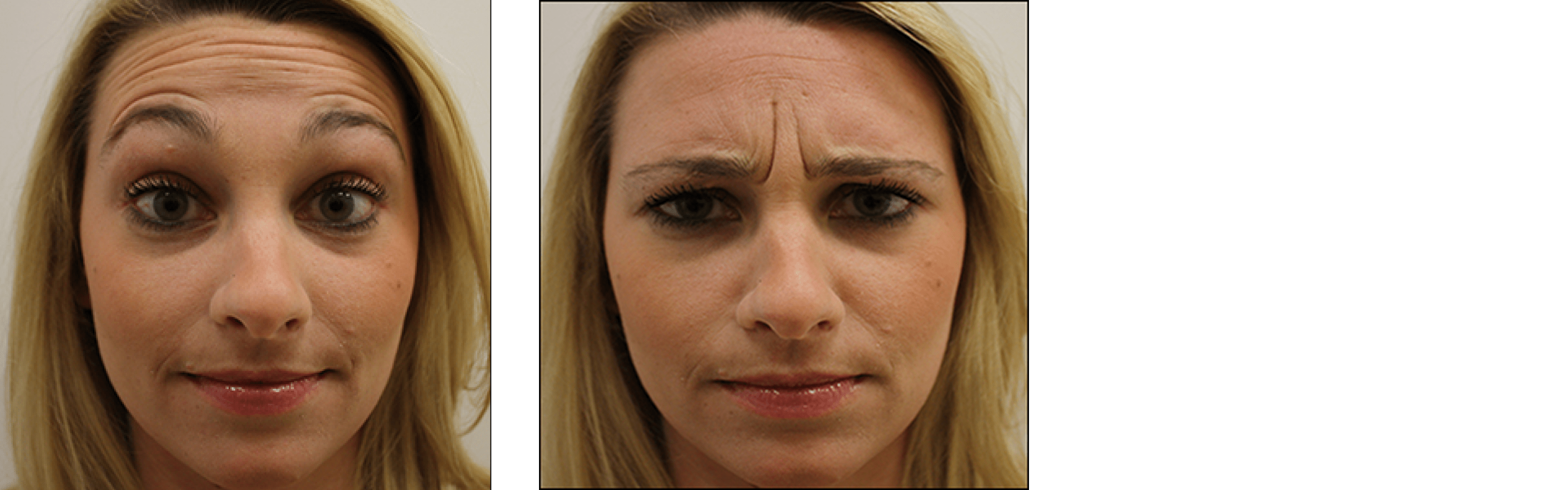 botox