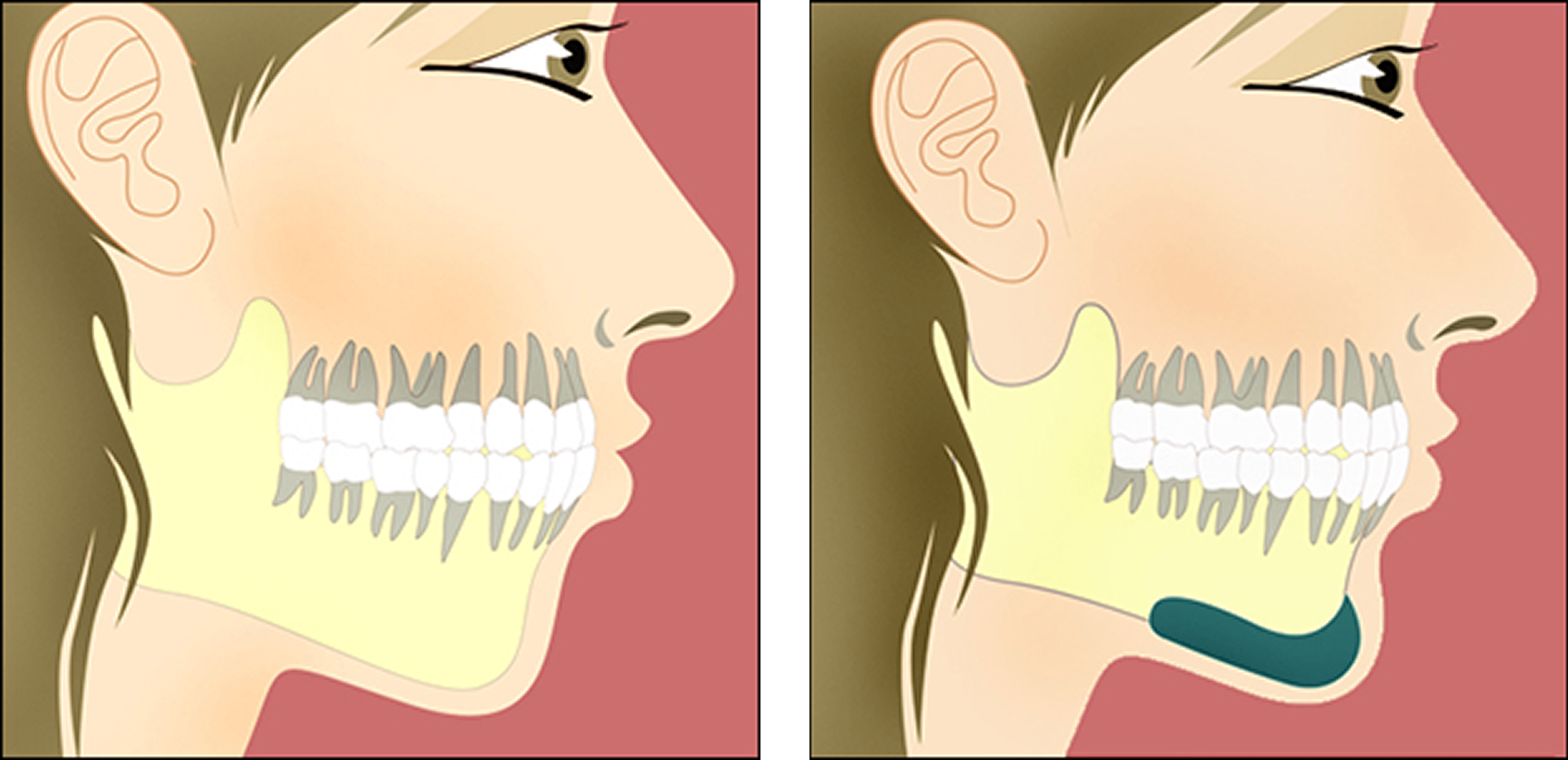 Facial Implants cheek chin