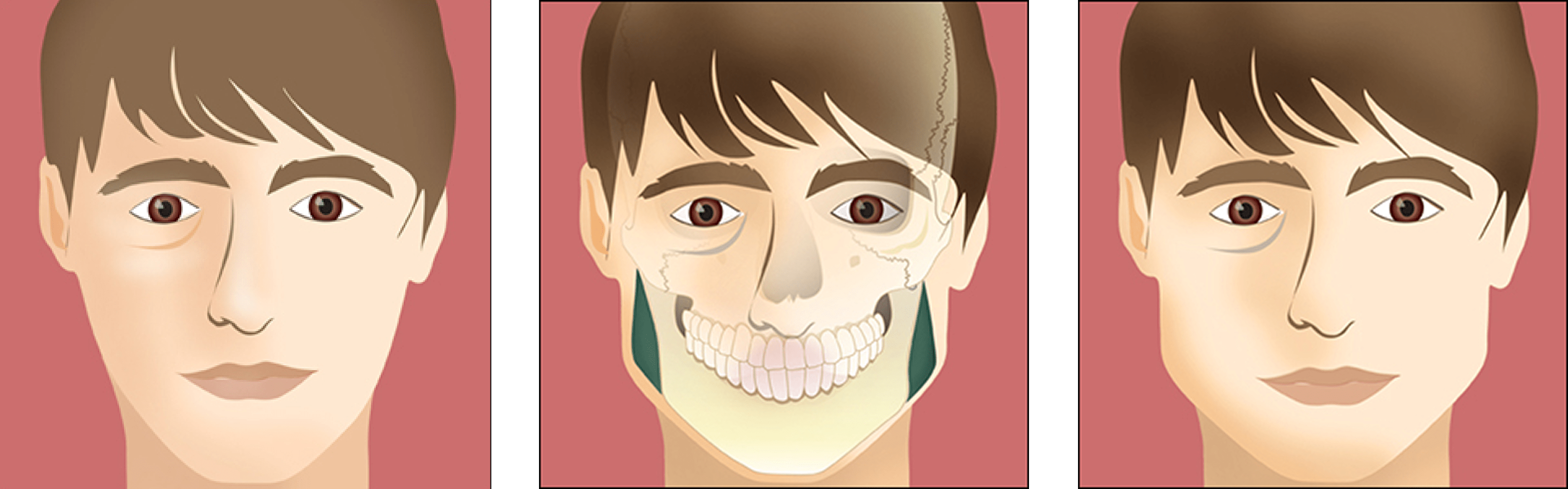 Facial Implants cheek chin
