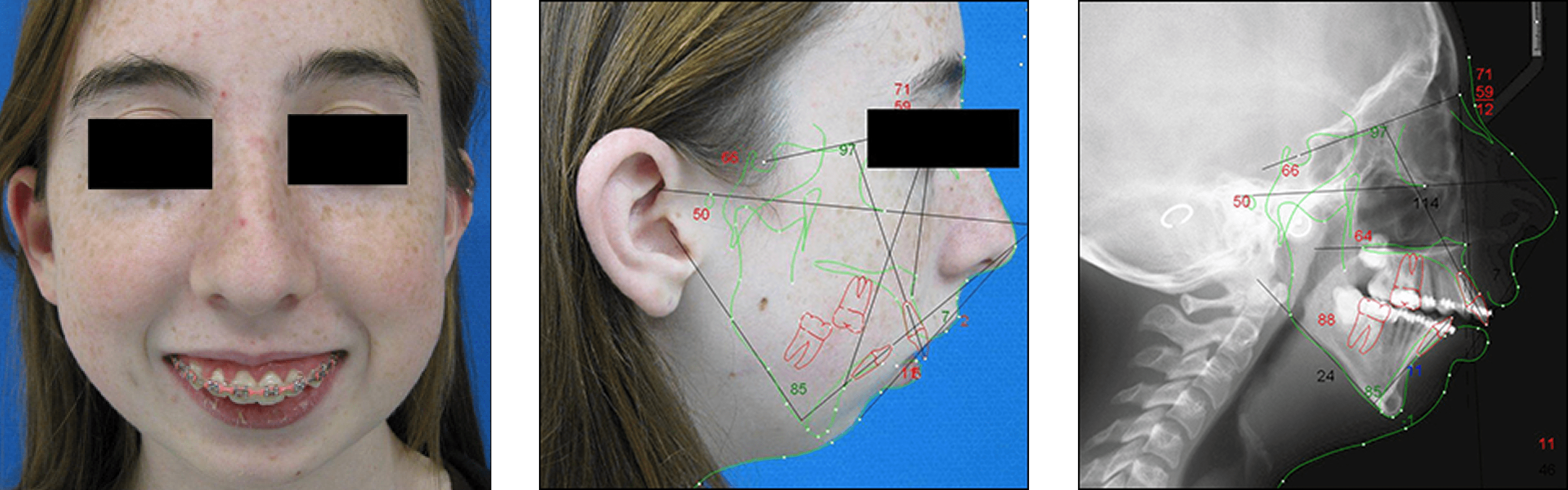 Corrective Jaw Surgery