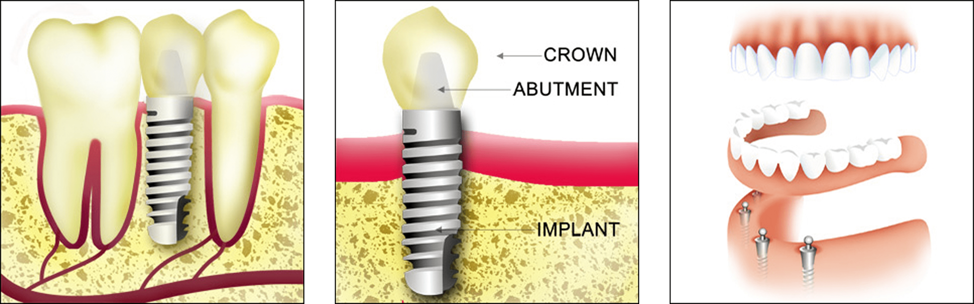 Dental Implant