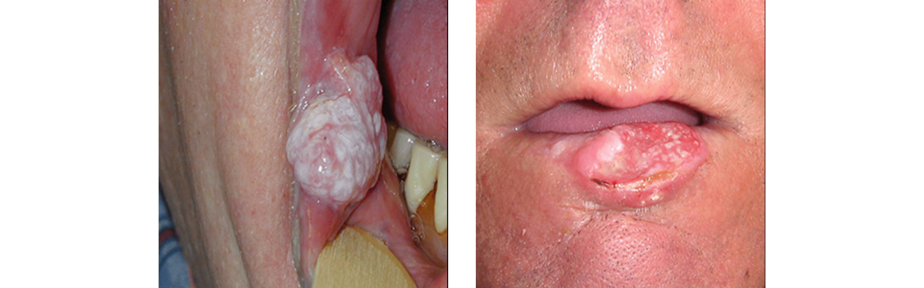 Oral Pathology