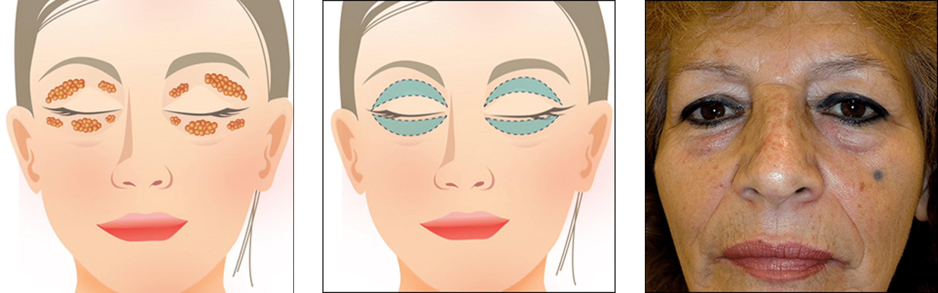 Eyelid Surgery