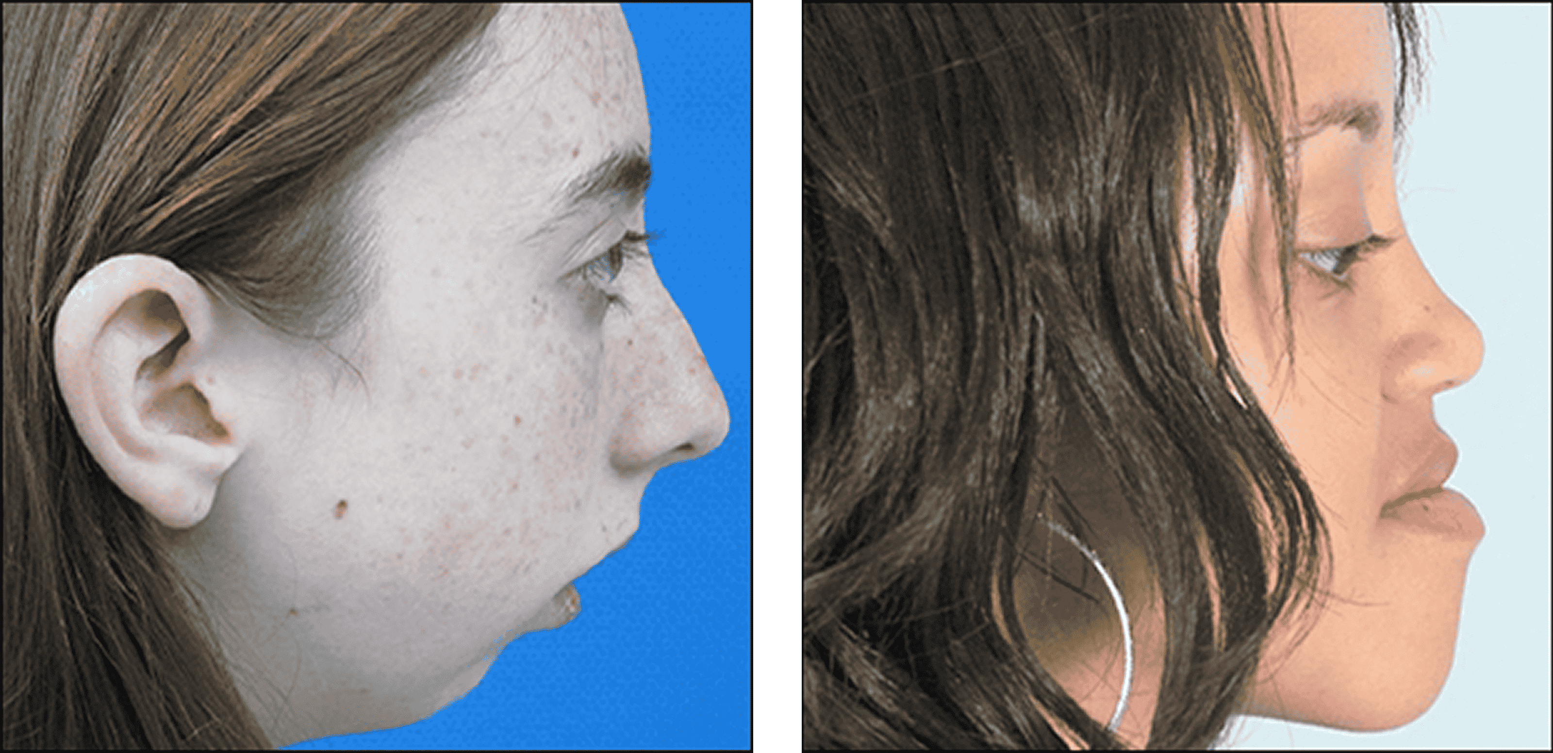 Chin Surgery