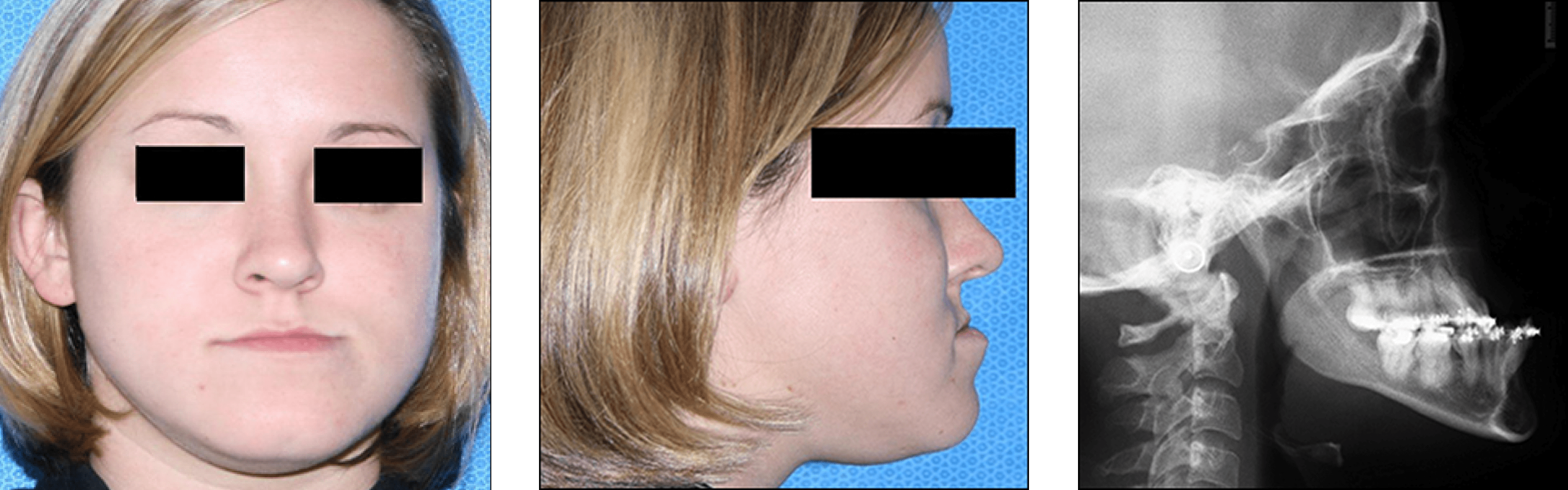 Corrective Jaw Surgery