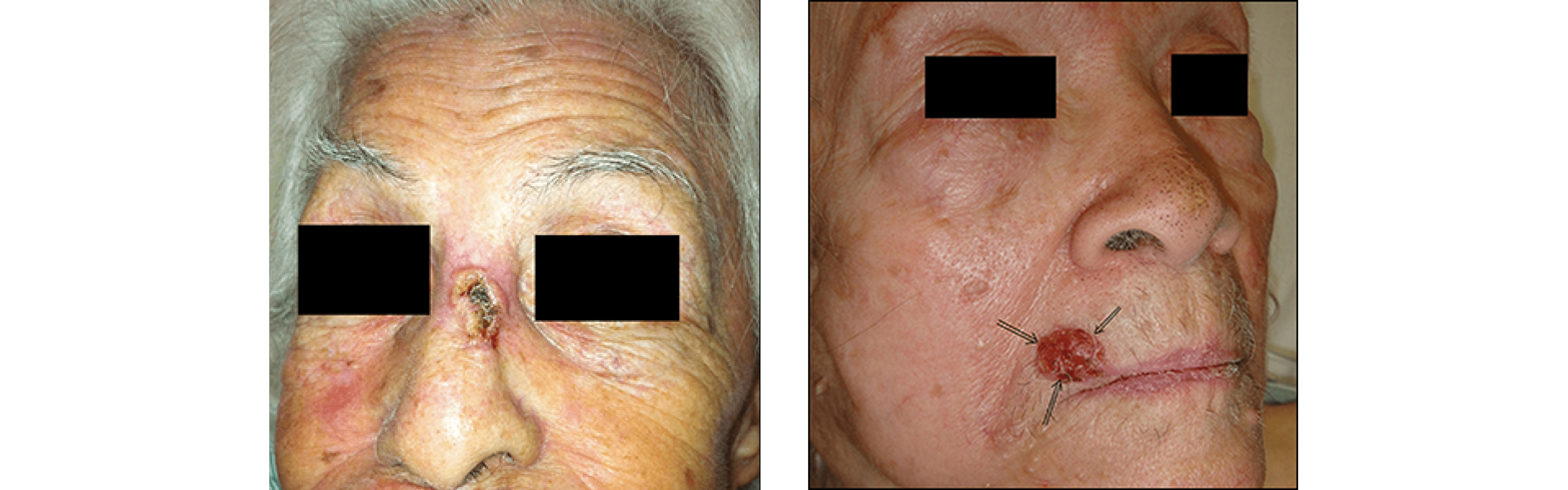 Skin Surgery (Mole and Cancer Removal)