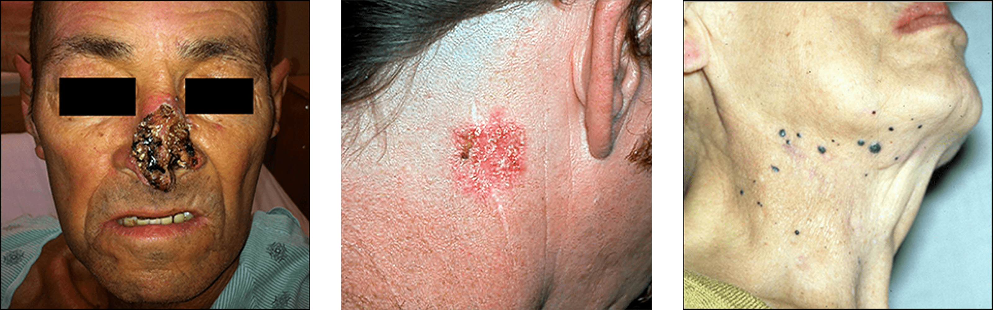 Skin Surgery (Mole and Cancer Removal)